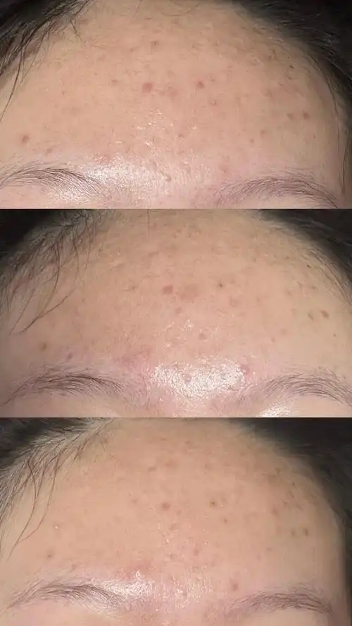 针清后恢复有图慎入针清当天和第一二三天起床一睁