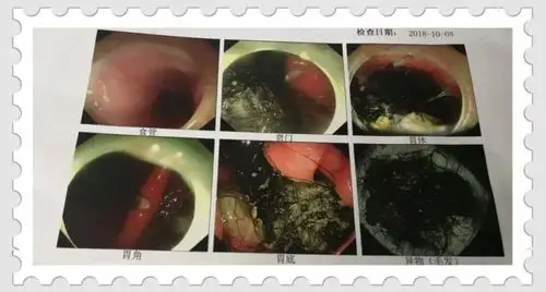 济源女孩爱吃头发,胃里一团!这种病家长们要留神