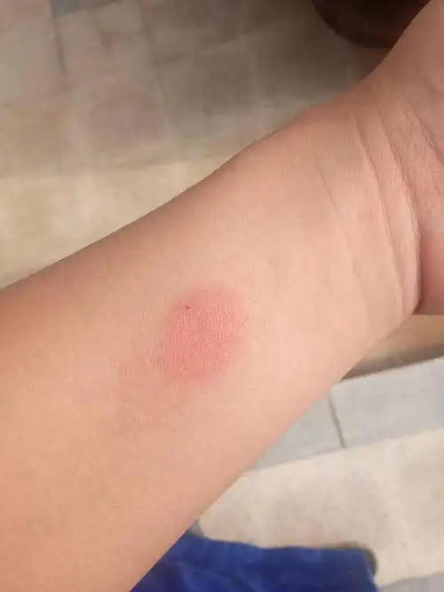 肺结核皮试48小时后,谁知道这样是怎么回事.