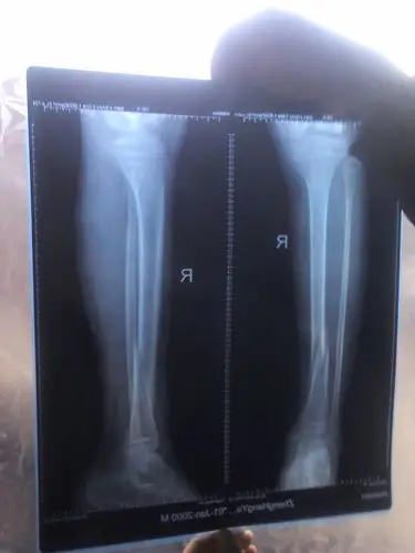 关于小腿骨科的问题x片!