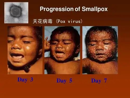 progression of smallpox 天花病毒 (pox virus) day   day   day