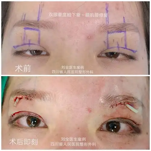 cfs～上睑下垂,用案例说话 - 好大夫在线