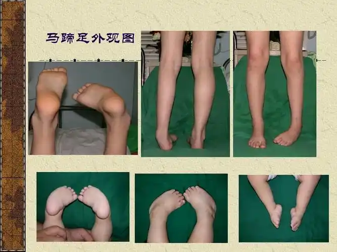 先天性马蹄内翻足讲课稿ppt