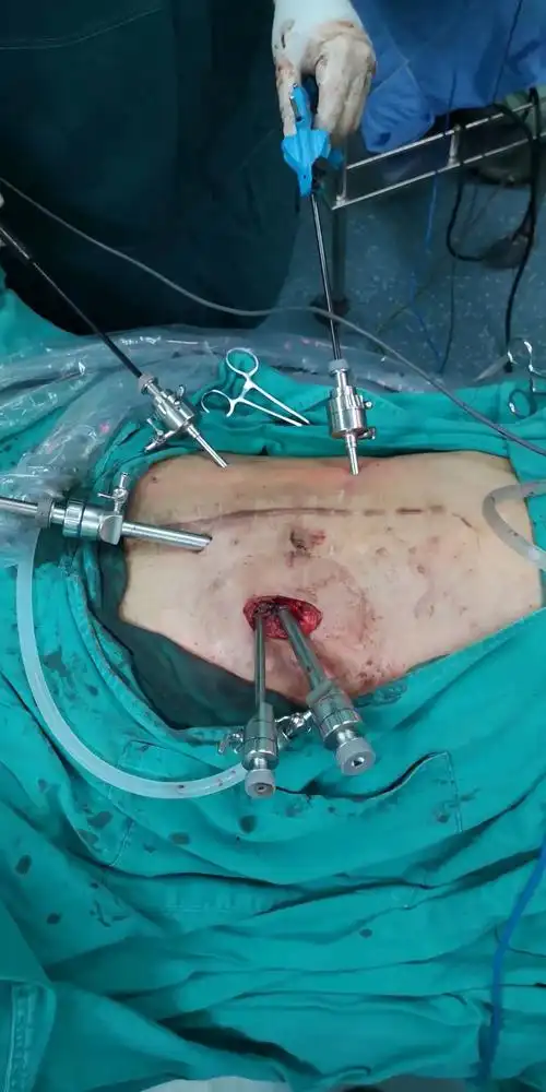 手术中,腹腔镜下打孔下器械,利用微型摄像头在腹腔内进行操作.