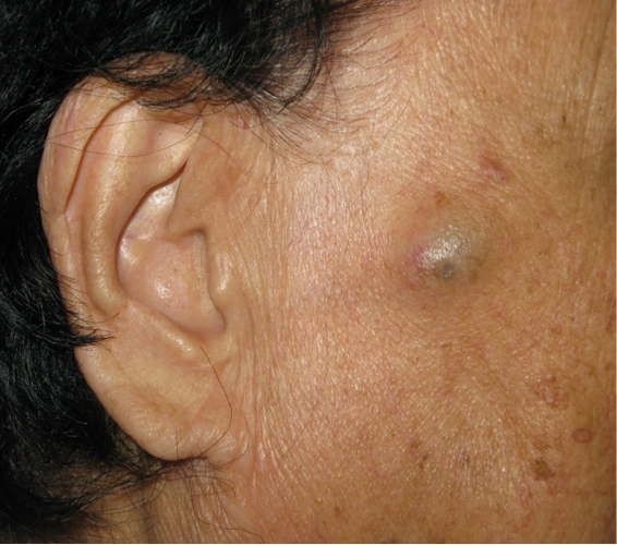 体表肿物该不该切除