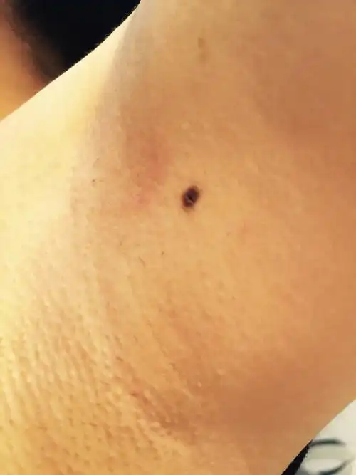 您好,我突然发现腋下长了一个黑痣,之前没有注意过,请您帮忙看看会不