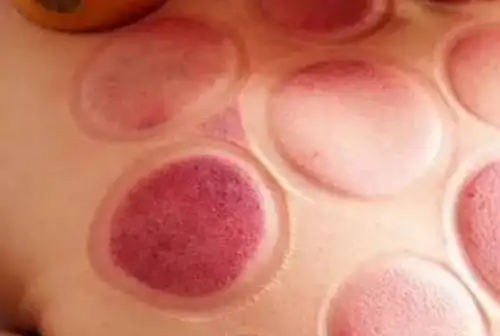 拔火罐出水泡怎么办?