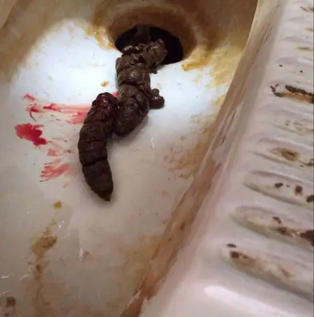 2013-11-01 吴雪飞 医师 我有痔疮,今天拉大便纸上有点血,那颗痔长在