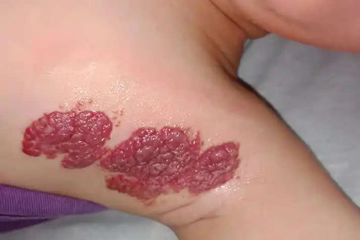 新生儿毛细血管瘤大多为米粒到豆大或更大的半球形红色小瘤,有时表面