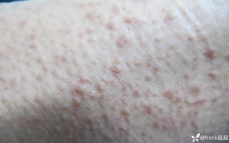 双手臂多发红褐色结节明确病理后是个罕见病皮肤病