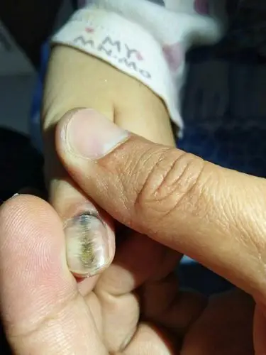 哪位皮肤科专业人士给看看孩子的指甲,虽然被她抠得不成样子,但仔细