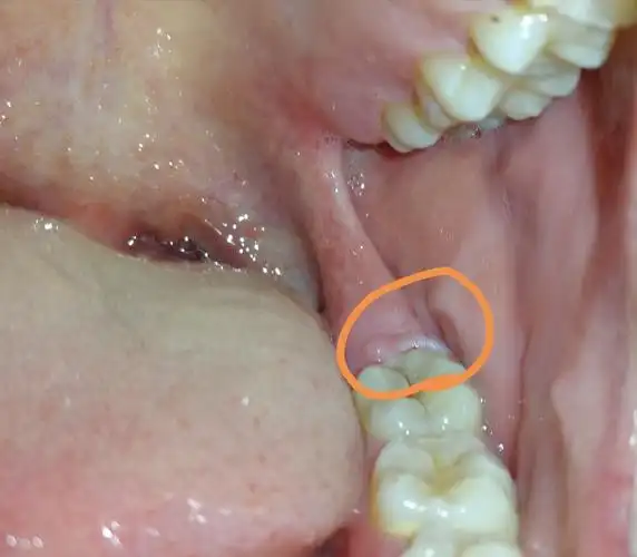 长智齿怎么办(长智齿怎么办快速止痛)