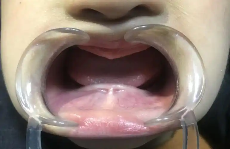 有一种先天不长牙叫外胚叶发育不全_儿童牙病_儿童牙病相关疾病 - 好