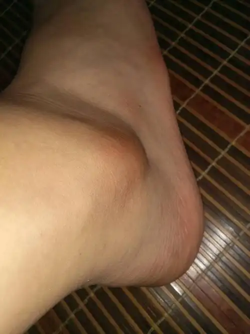 脚旁边的骨头突出怎么办,是最近放假了才变成这样的