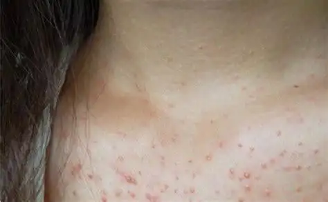 肝病身上起红疙瘩图片