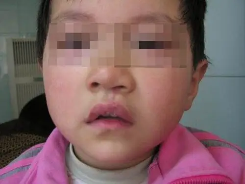 突破传统思路 巧治"隐性兔唇"