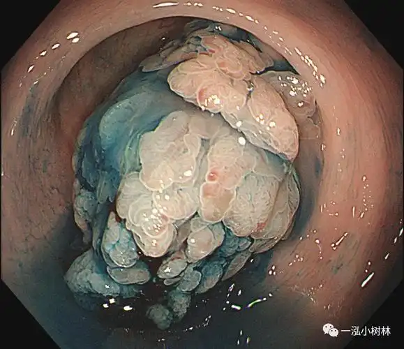 绒毛管状腺瘤或者tsa?