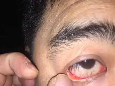 眼结石的颜色是这样一个白色的小颗粒