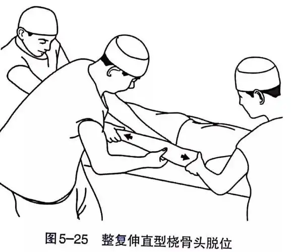 各部位骨折的完美复位手法你值得拥有