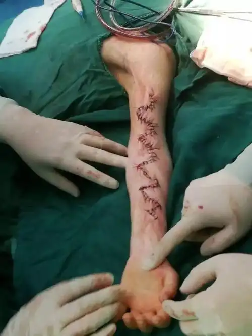 我院骨一科成功开展一例小儿上肢线性瘢痕挛缩松解z字皮瓣成形术