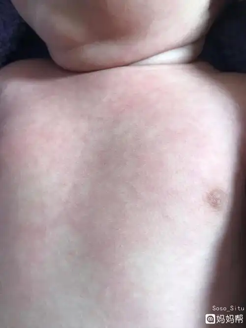 婴儿皮肤发花成状,是网状青斑吗,大了可以自愈吗?