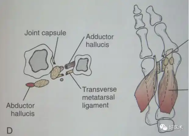 拇外翻治疗策略与最优术式选择,必备基本功!