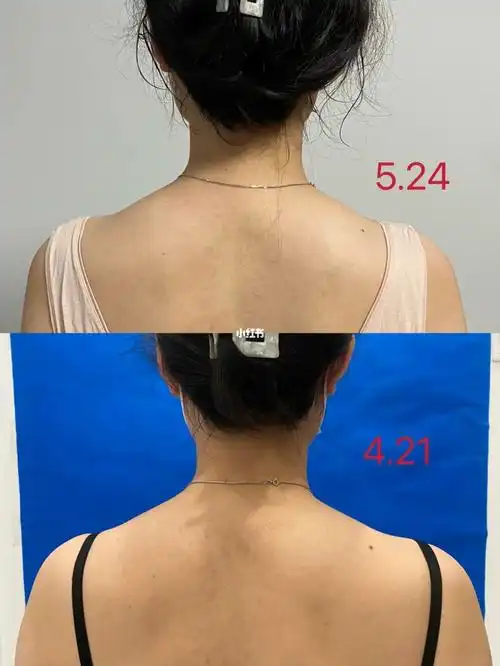 只能说没有这么神奇,如果是追求直角肩效果的可以放弃了#瘦肩针