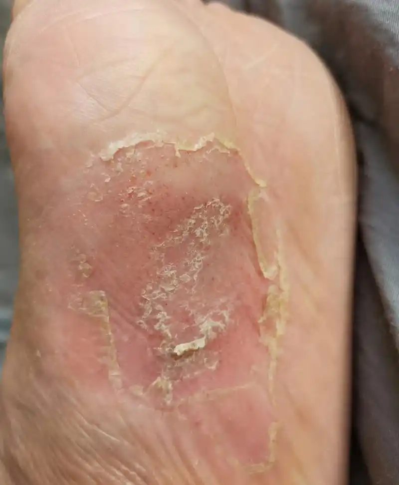 小伙脚心长湿疹,一热就钻心的痒,中医辨证:阴虚血燥生热!