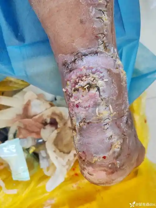 自诉20多天前外院小腿皮瓣修复术后出院回家4天前发