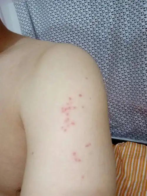 早上起床 发现胳膊上 好多红点 家人说是蚊子咬的 但是蚊子这么厉害嘛