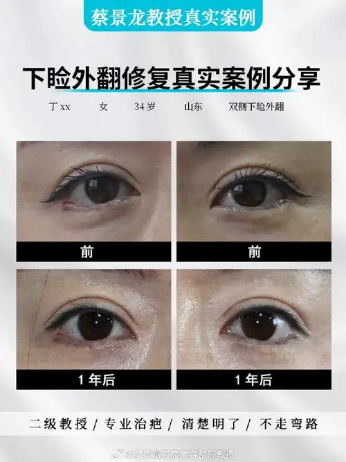 蔡景龙教授##下睑外翻修复##下睑外翻