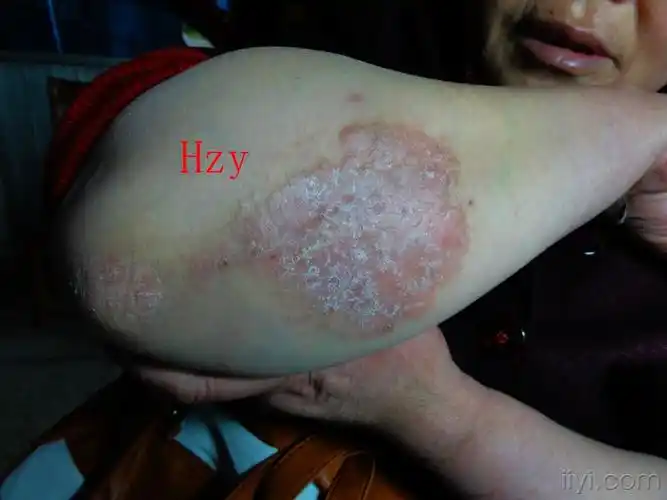 两前臂皮损二年神经性皮炎