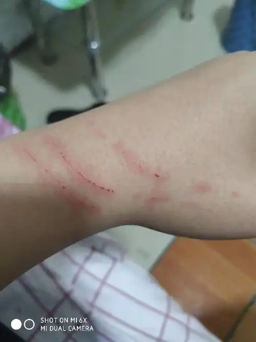 我被一只小的猫抓破皮了,用猫指甲抓的,我记得之前看过说狂犬病病毒是