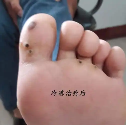 跖疣的冷冻·治疗