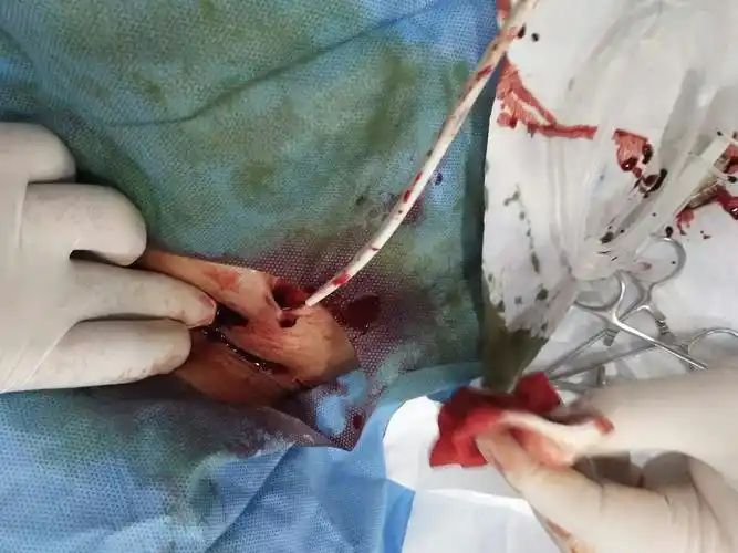 一例留置11年的血透长期导管换管记