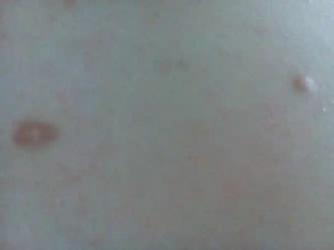 胸口挤了痘痘,形成这样的两个较大的凸起肉球,这是怎么回事,都要一年