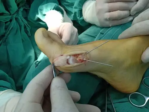 双足拇外翻chevron矫形术