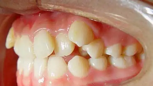 多生牙的疾病治疗