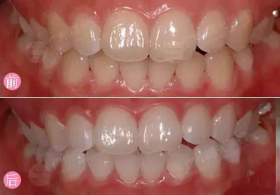 牙齿美白前后对比图