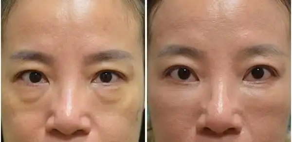 例如:凹凸不平的眼袋,深深的泪沟,下弯的下眼睑,松弛的赘皮及凹陷的