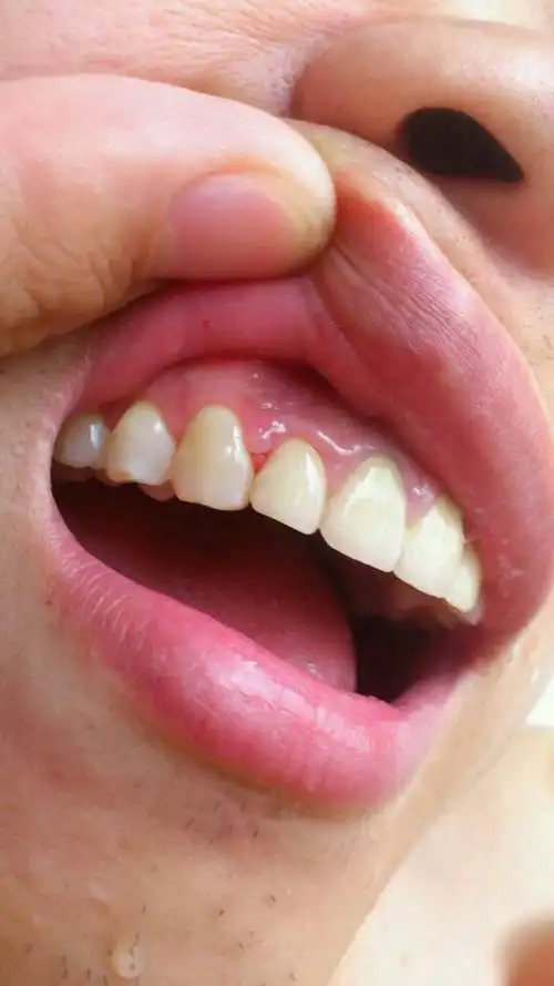 有医生帮忙看看嘛,这个星期一起床牙龈上长了个肉疙瘩,不疼不痒,刷牙