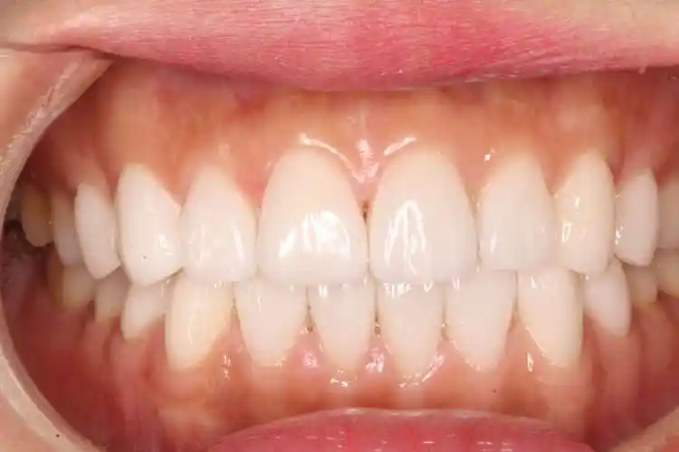 其实我牙齿还是挺整齐的,就是不太白拍照也不好看.