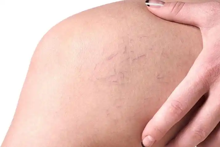 大腿内侧静脉曲张图片