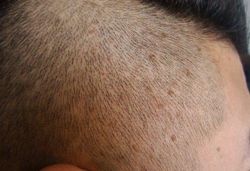 头皮型银屑病图片51