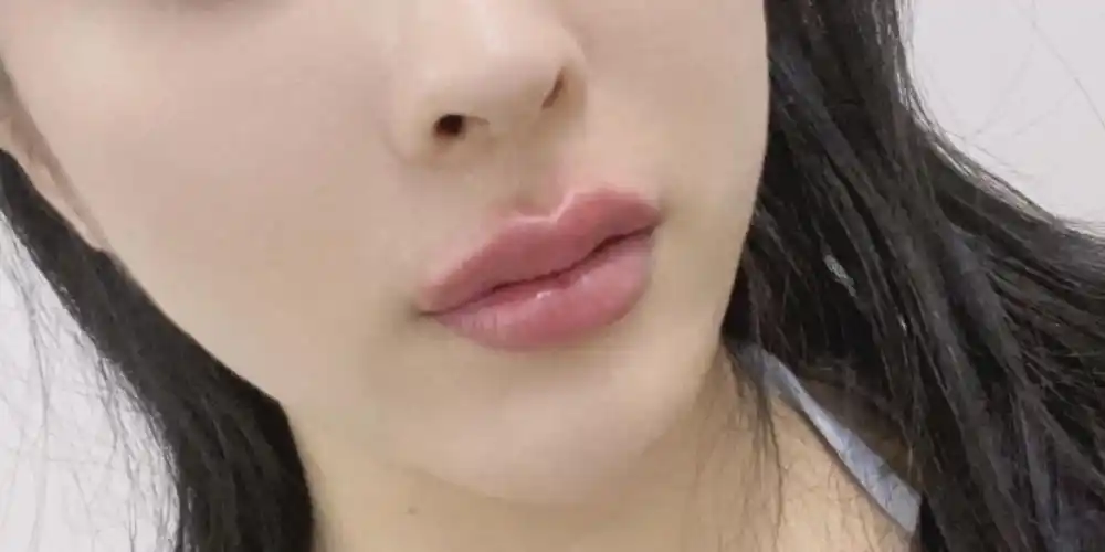 嘟嘟唇大家都几天消肿得