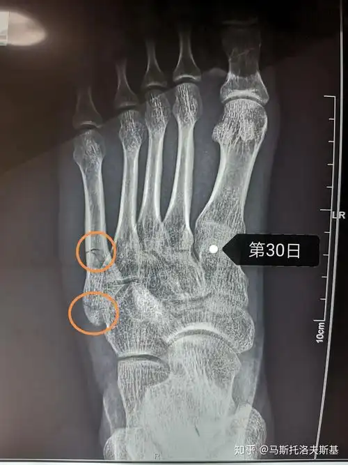 左脚第五跖骨骨折