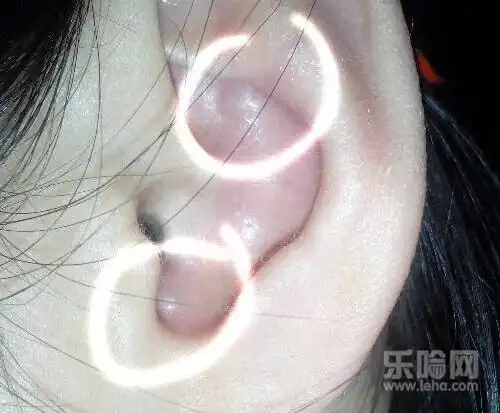 左边鼻孔里有一个红色的鼓鼓的小包,一碰就很疼,软软的,连着鼻子外面