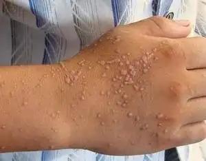 肛门疣病的肛门疣病的分类