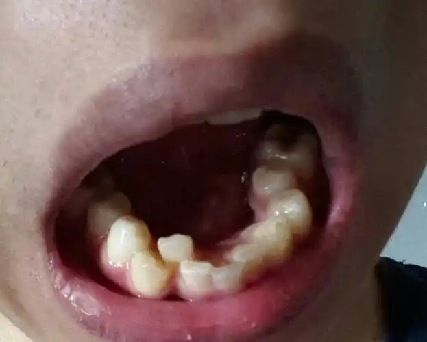 请问我有一个牙齿凹进去了,怎么办,能矫正吗,还是把点