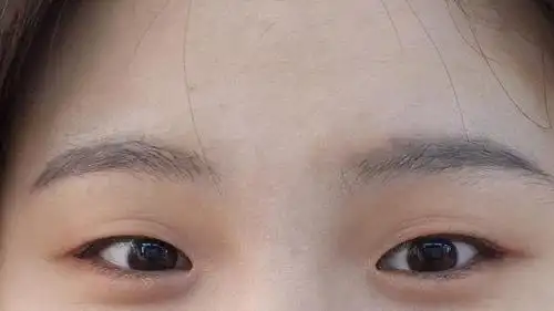 两眼间距太宽该咋办